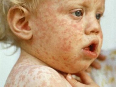 Sarampo aumentou 100 vezes na Ucrânia no entorno de onde EUA manteve laboratórios biológicos